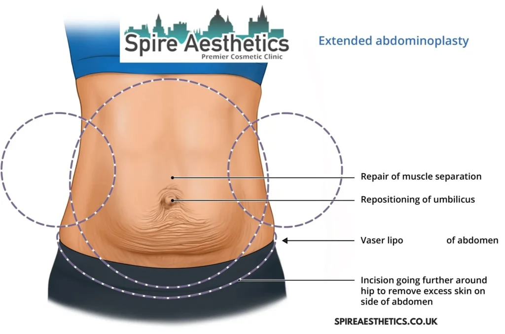 Understanding Loose Skin After Gastric Band Houghton Regis Surgery and HIFU Treatment