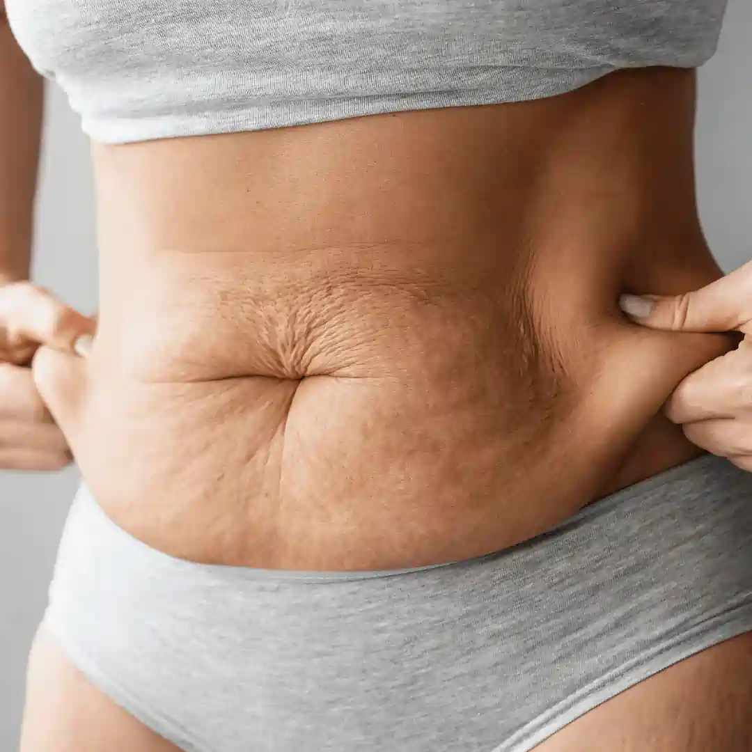 Is It Normal to Have Loose Skin After Pregnancy Houghton Regis?