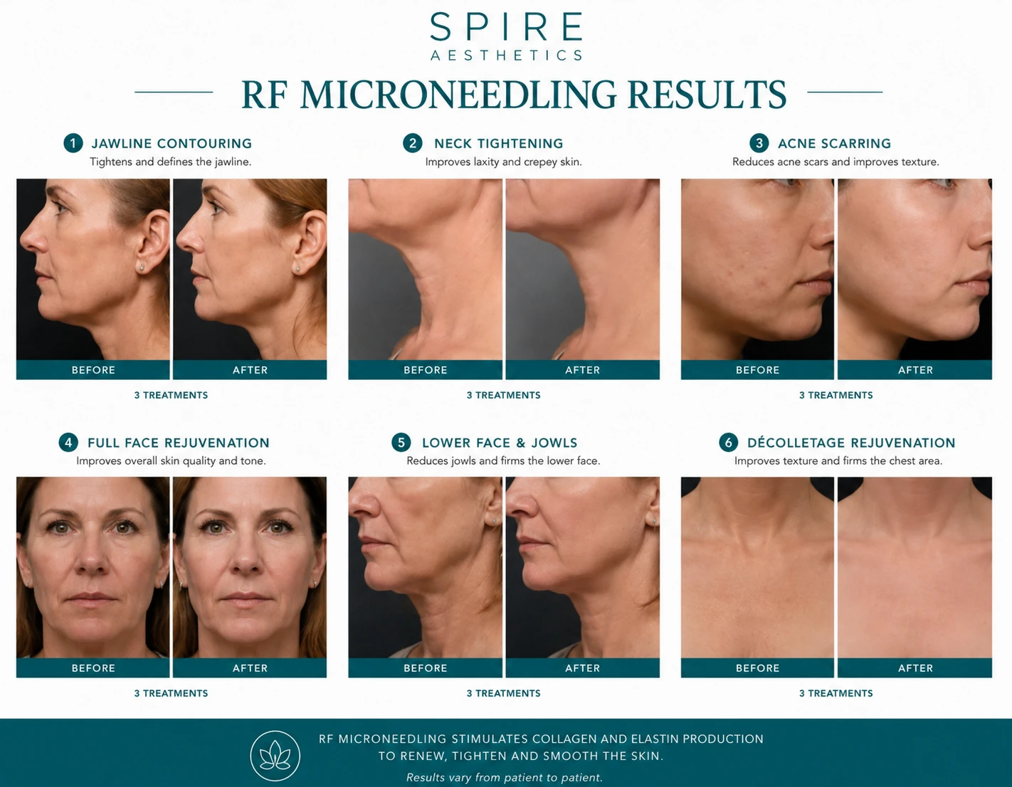 RF Microneedling Skin tightening Houghton Regis results
