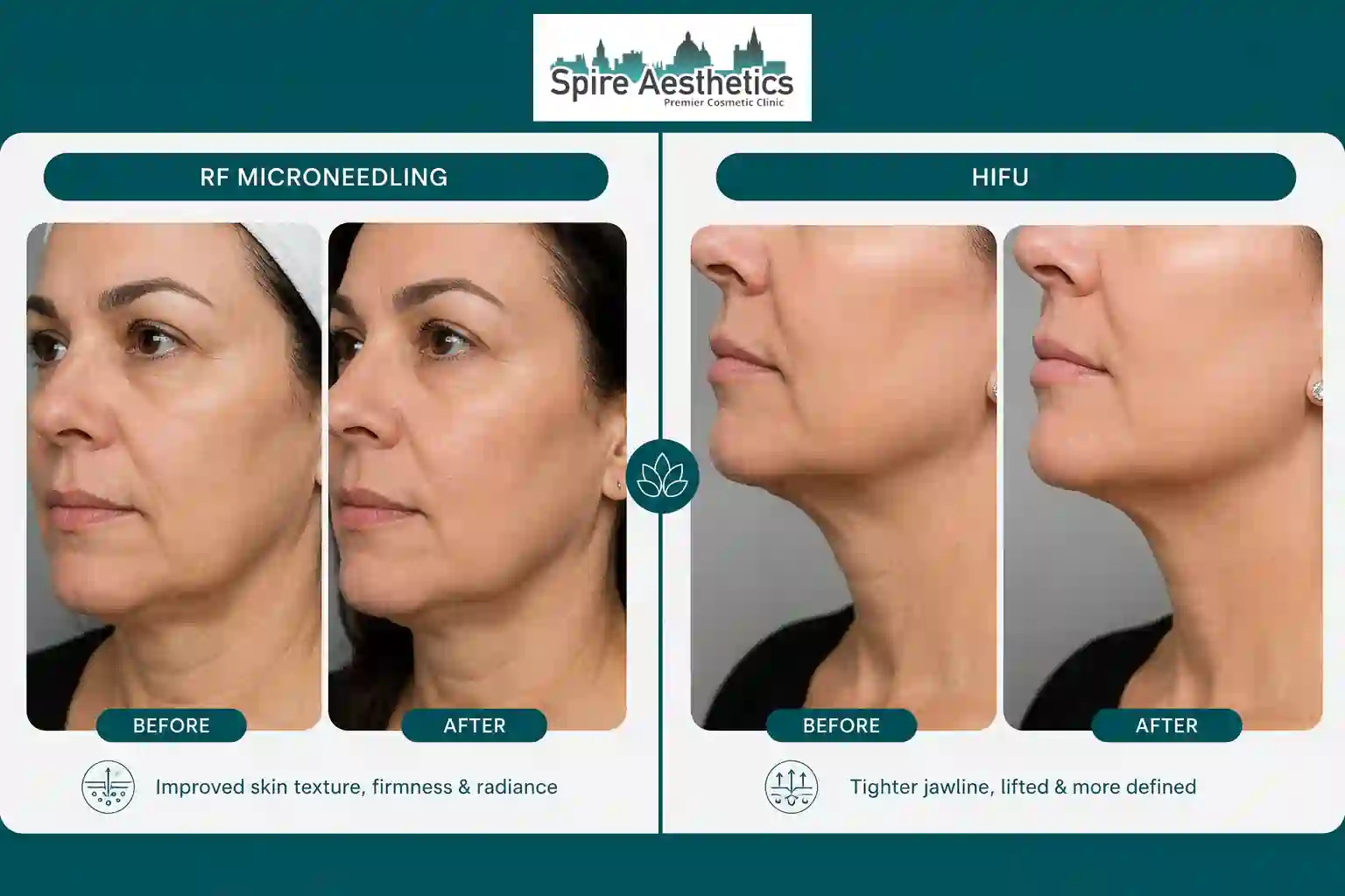 Can RF Microneedling and HIFU Be Combined Houghton Regis?