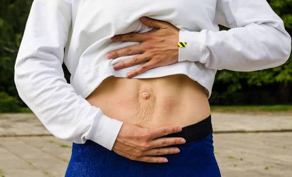 When Could Diastasis Recti Be the Missing Piece of the Puzzle Houghton Regis?