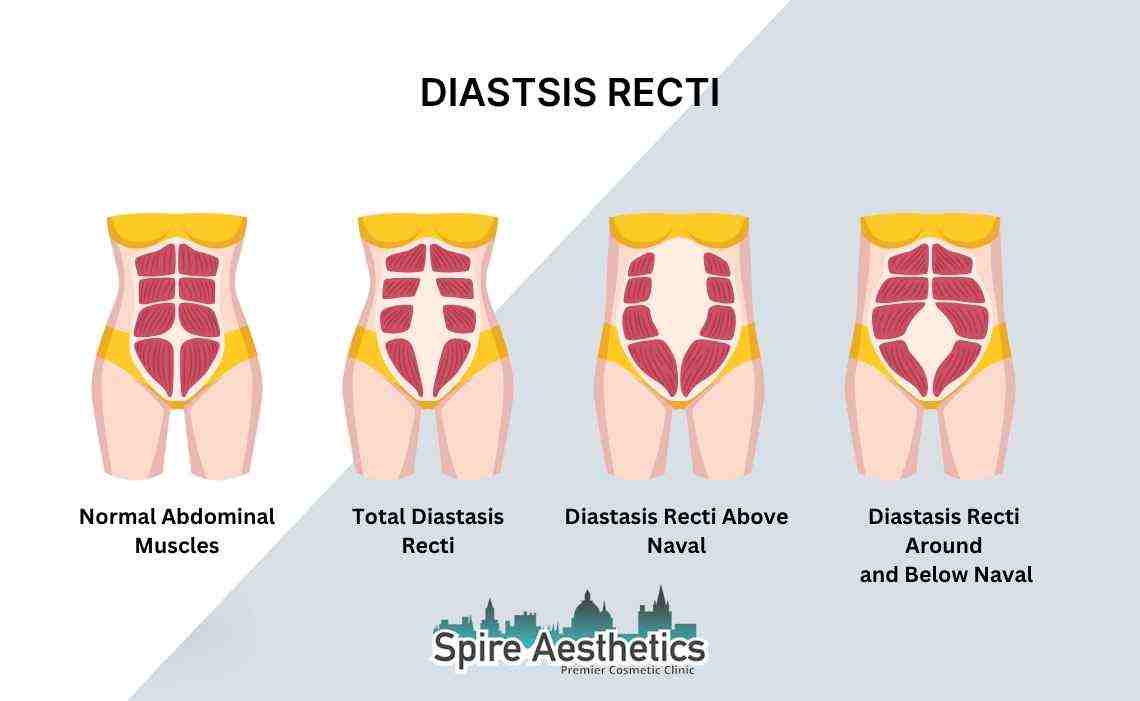 Is Non-Surgical Diastasis Recti Treatment Right for You? Common Concerns Answered Houghton Regis